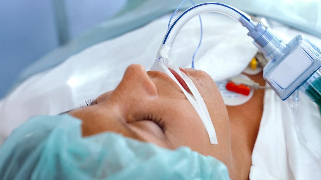 Severe Tracheal Stenosis After Prolonged Intubation