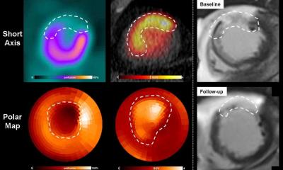 PET imaging reveals which patients will (or will not) recover after heart attack • healthcare-in-europe.com