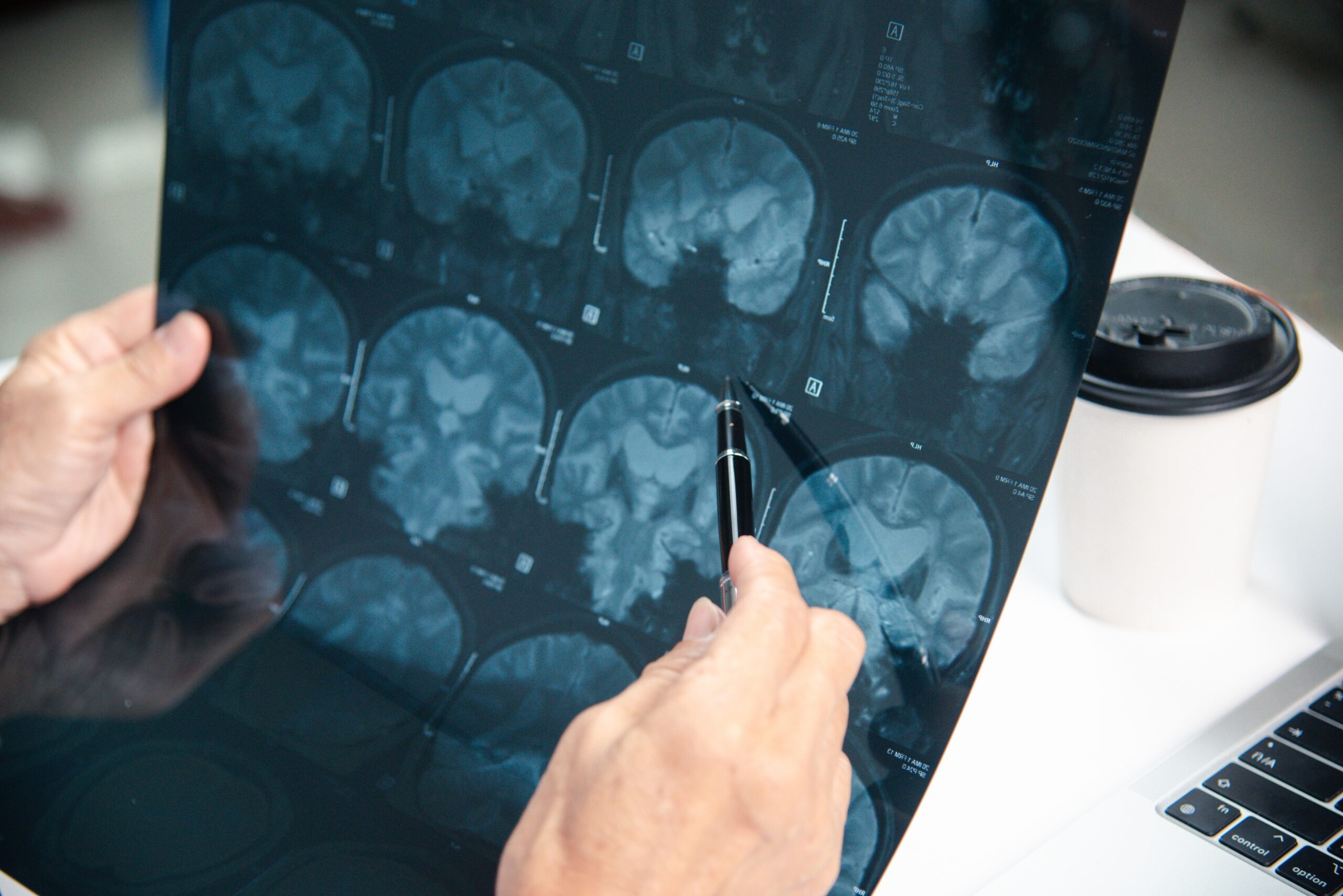 Brain’s circHomer1 RNA offers insights for future neurological treatments