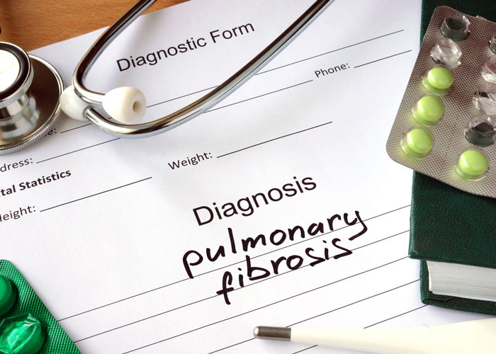 Pulmonary fibrosis: new drug slows and reverses lung scarring