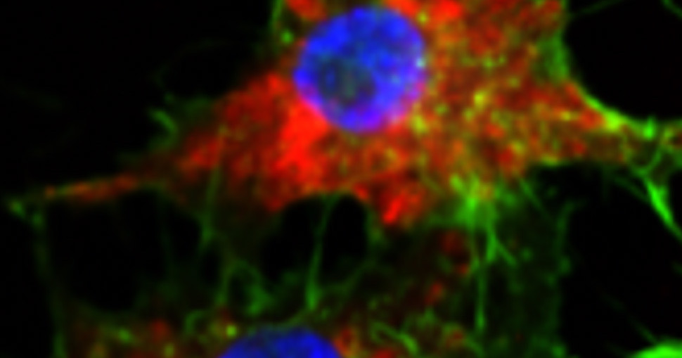 New nanomedicine wipes out leukemia in animal study