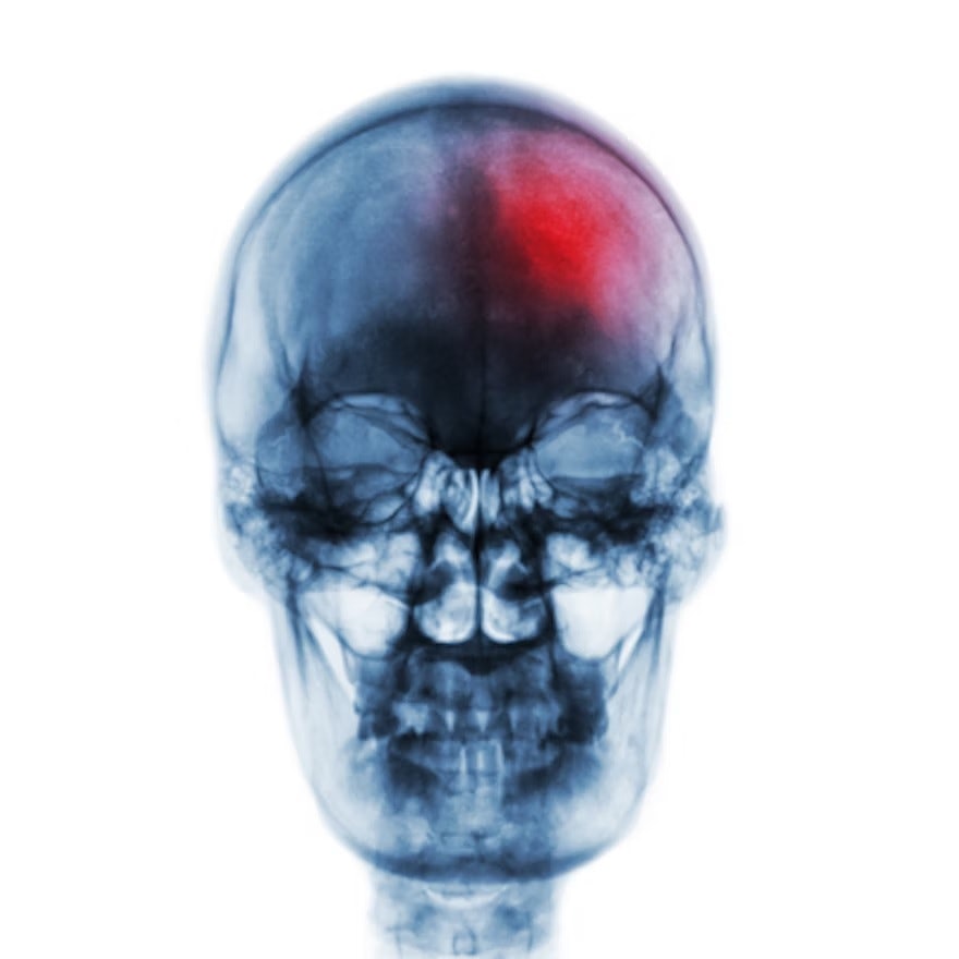 EVT improves outcomes in stroke patients over age 90