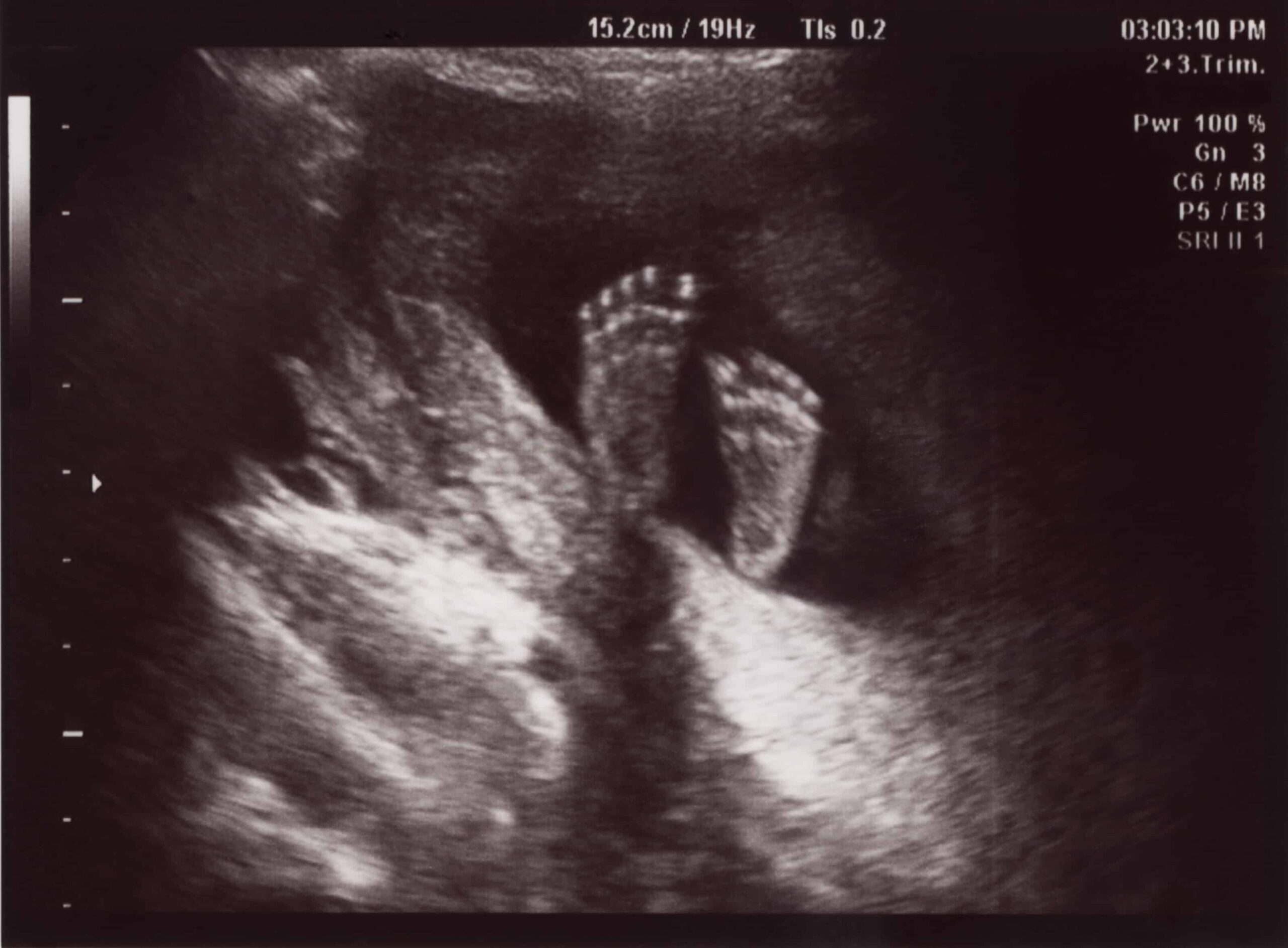 Medical Journal Screed Decries All Fetal Personhood Laws