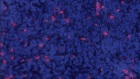 Immune Altering Drug Hits Cancer In Stomach