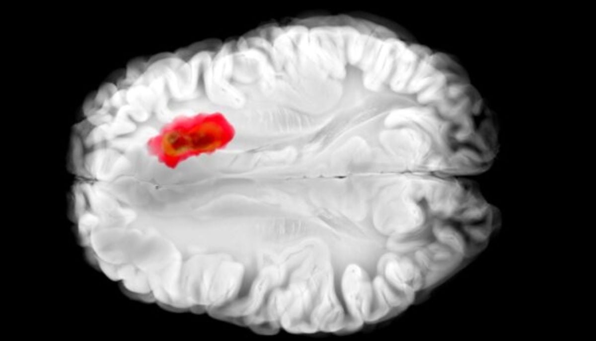 Common drug emerges to fight against most lethal brain cancer