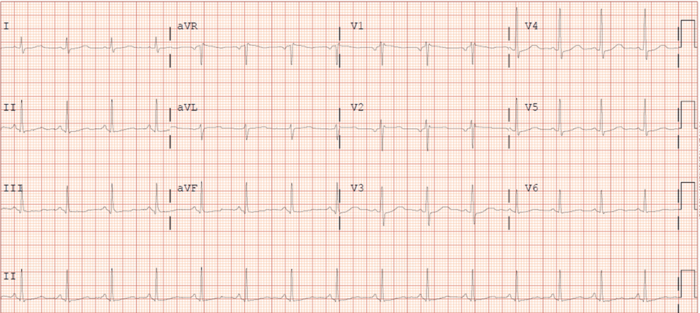 Myocardial Bridging in a 37-Year-Old Female Patient: A Case Report and Management Approach