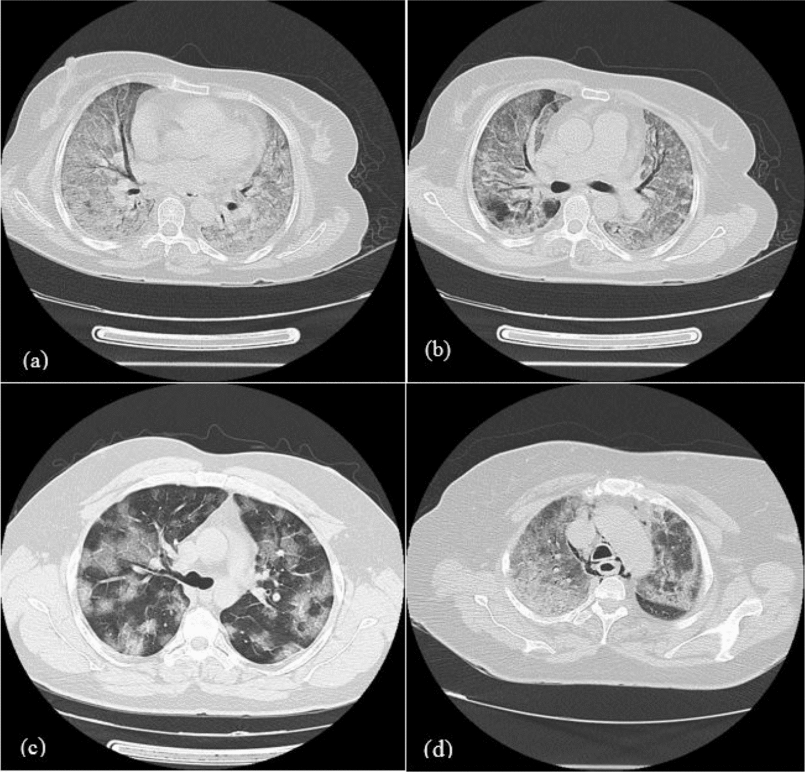 External validation of CT-based severity scoring systems to determine prognosis of pneumonia caused by COVID-19 virus: a multicentric cohort study | Egyptian Journal of Radiology and Nuclear Medicine