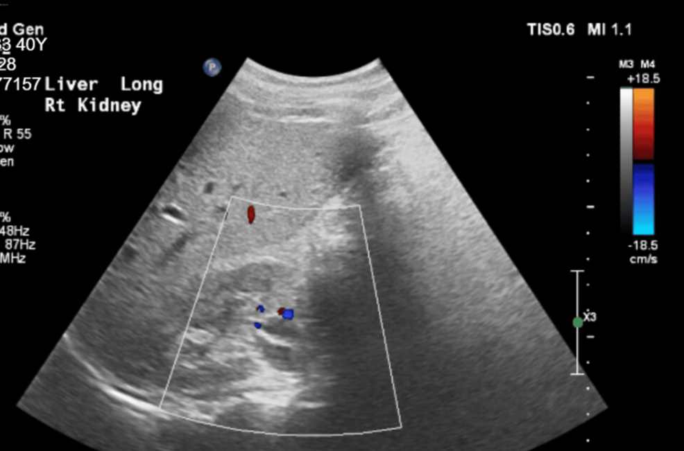 Successful Spinal Anesthesia in a Patient With Severe Coagulopathy From Acute Liver Disease of Pregnancy Undergoing Cesarean Section: A Case Report
