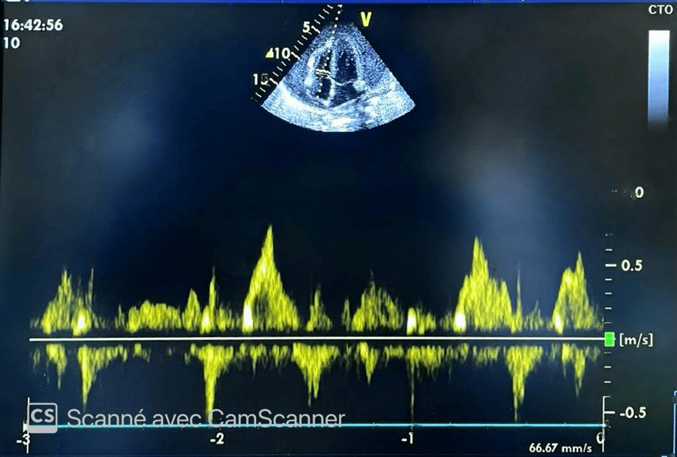 Cardiac Tamponade Due to Purulent Pericarditis in an Immunocompetent Patient