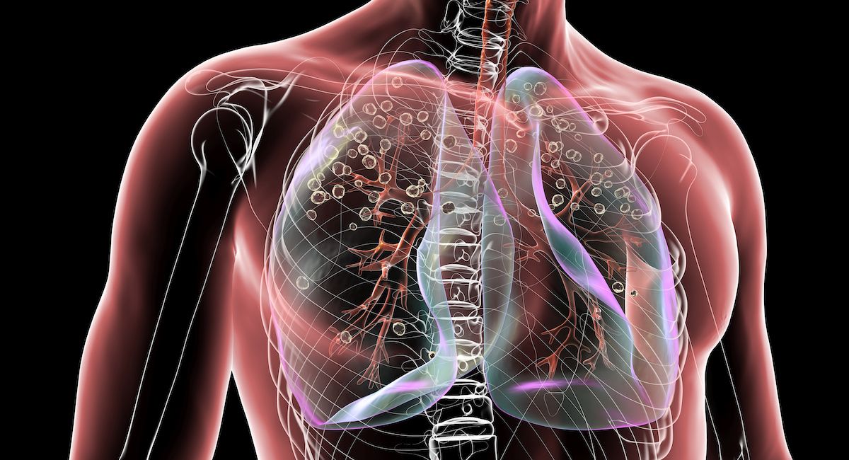 Genetic, Clinical Variables Can Predict Pulmonary Fibrosis Risk in Early Rheumatoid Arthritis