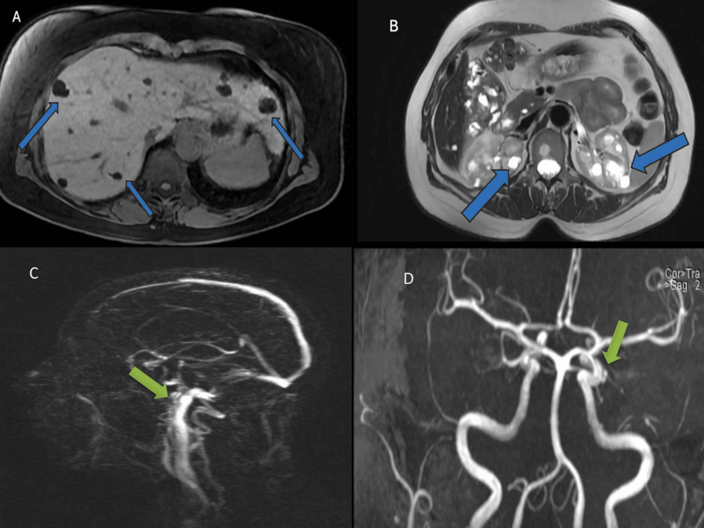 Molecular Diagnosis and Identification of a Novel Pathogenic Variant in Autosomal Dominant Polycystic Kidney Disease (ADPKD): A Case in Full Bloom