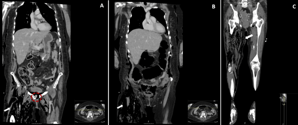 Necrotizing Fasciitis With Pelvic Osteomyelitis: A Fulminant Disease