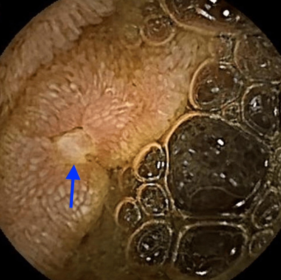 Life-Threatening Overt Small Bowel Bleeding From Jejunal Crohn’s Disease