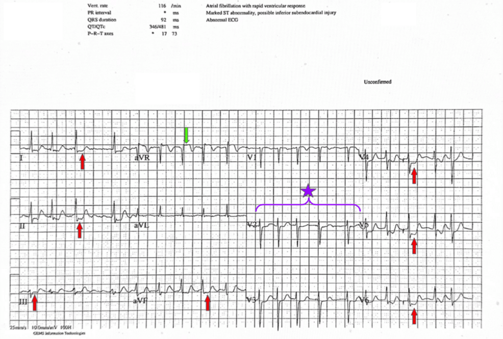 Managing Dialysis-Associated Haemodynamic Instability in Critical Calcific Left Main Stem Disease With Tachycardia-Bradycardia Syndrome Using Intravascular Lithotripsy-Assisted Percutaneous Coronary Intervention and Permanent Pacemaker Implantation