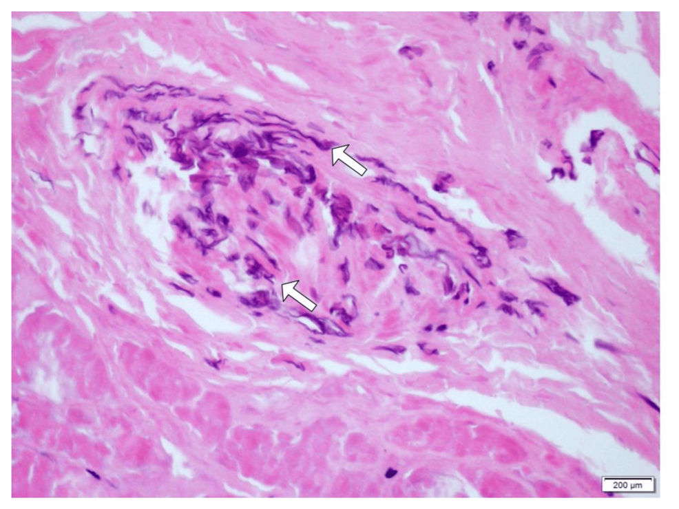 Diabetic Ketoacidosis Complicated With Extensive Rhinocerebral Mucormycosis and Bilateral Amaurosis in a Pediatric Patient
