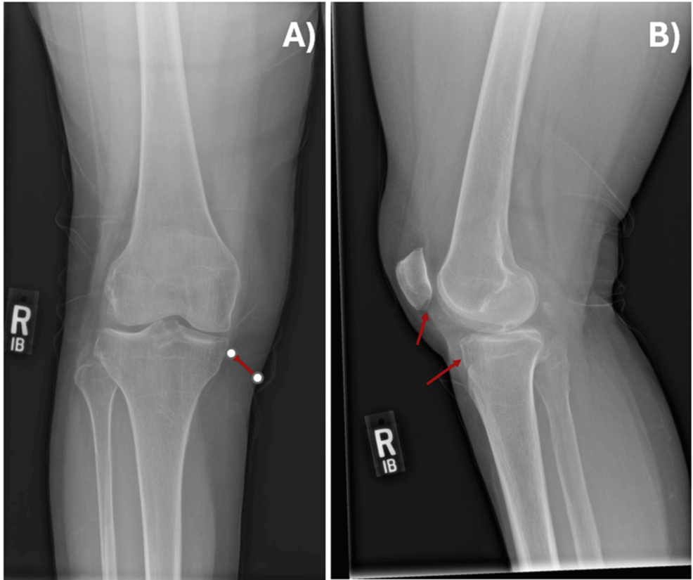 A Rare Presentation of Knee Pain in a Patient With History of Lung Cancer