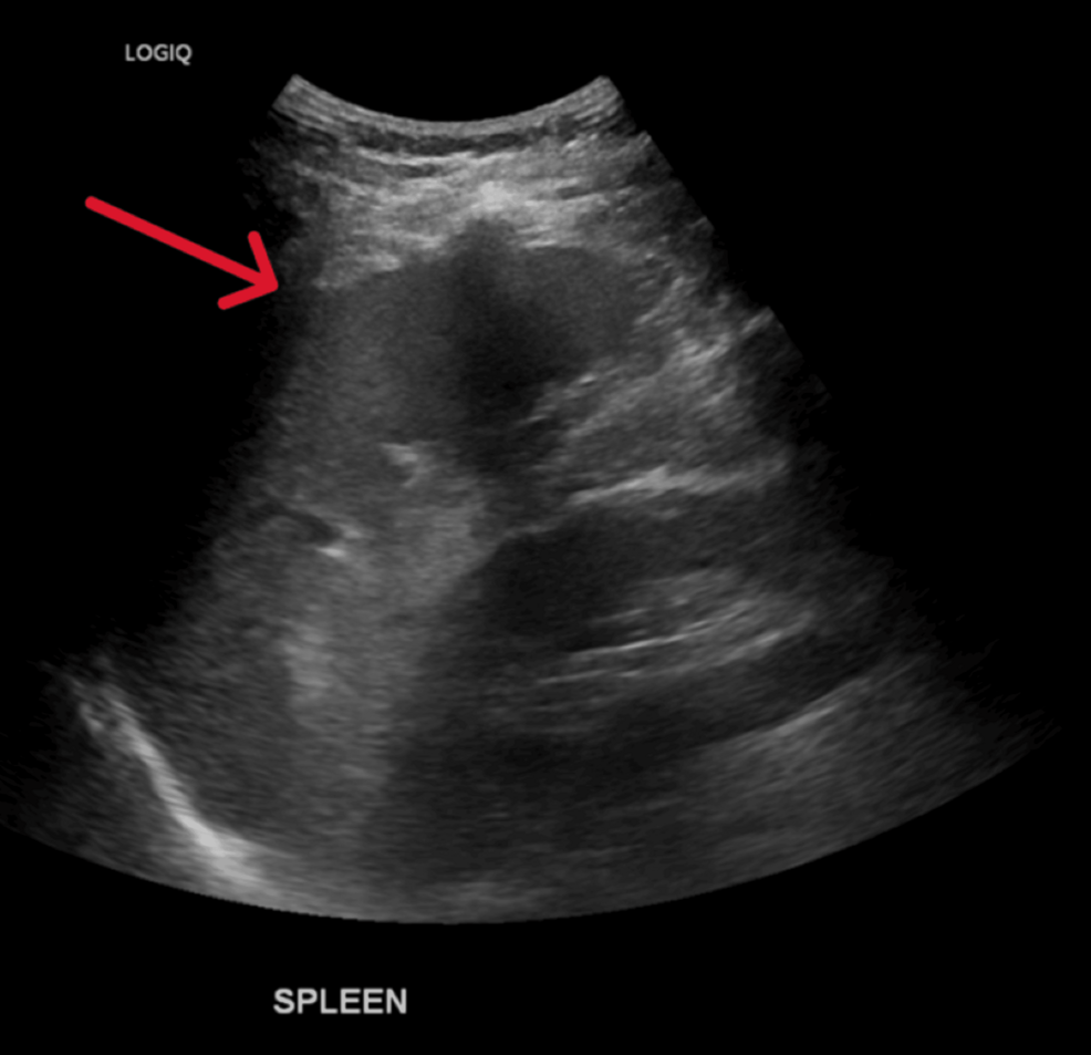 Primary Epstein-Barr Virus Infection Presenting as Cholestatic Hepatitis Without Infectious Mononucleosis in an Immunocompetent Middle-Aged Adult: A Case Report