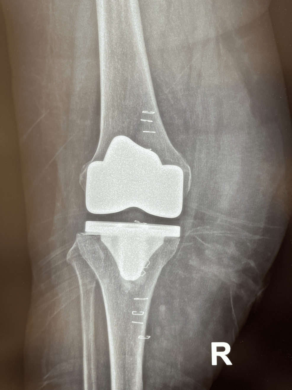 A Morel-Lavallee Lesion After Total Knee Arthroplasty and Aggressive Physical Therapy Manipulation: A Case Report and Review of the Literature