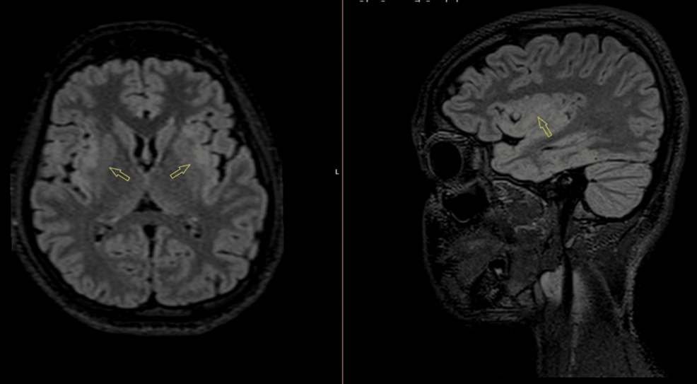 Multifocal Presentations of Myelin Oligodendrocyte Glycoprotein Antibody-Associated Disease (MOGAD): A Case Series From a District General Hospital in South East England