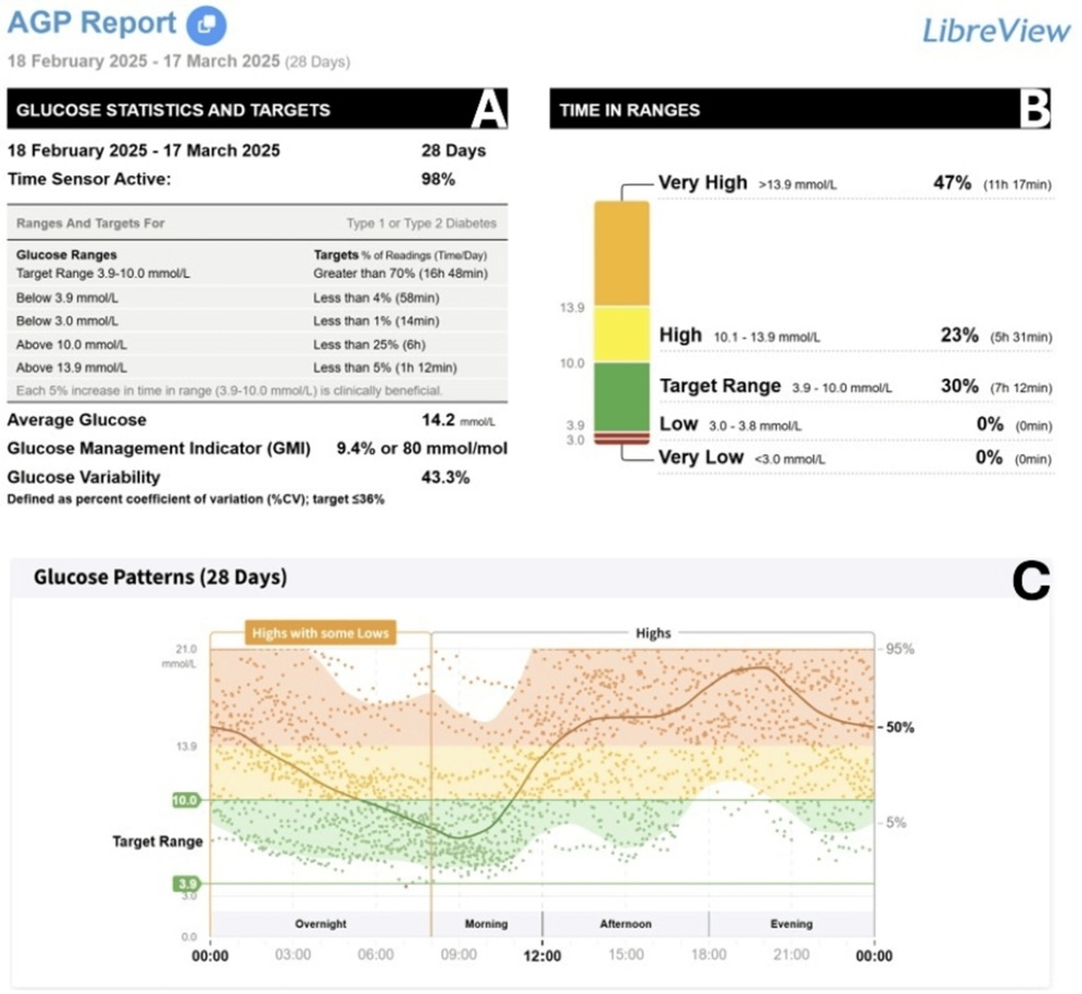 Redefining Cystic Fibrosis-Related Diabetes Management With Tirzepatide: A Case Report