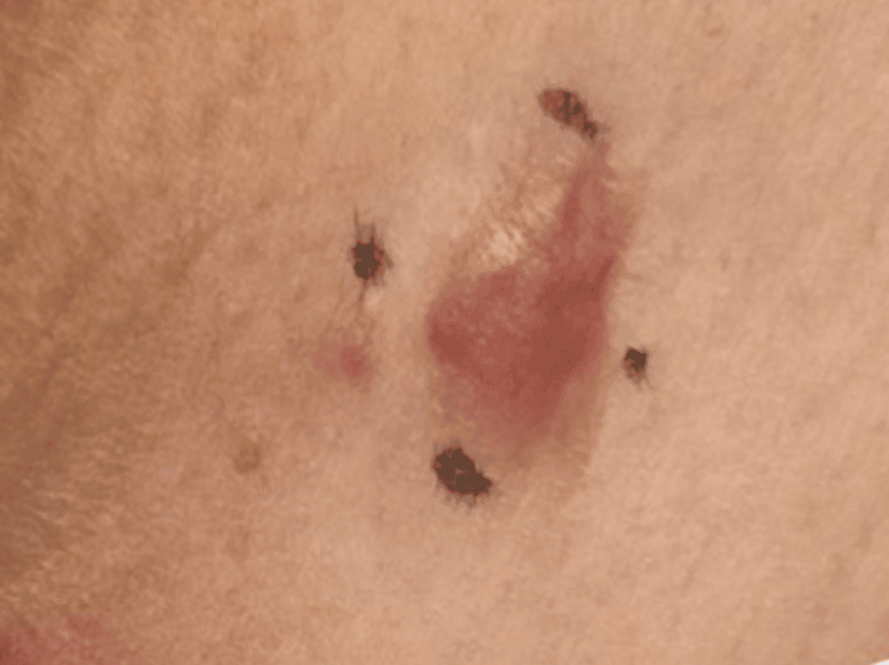 Dermatofibrosarcoma Protuberans of the Clavicular Skin in a 70-Year-Old Woman: Case Report and Management