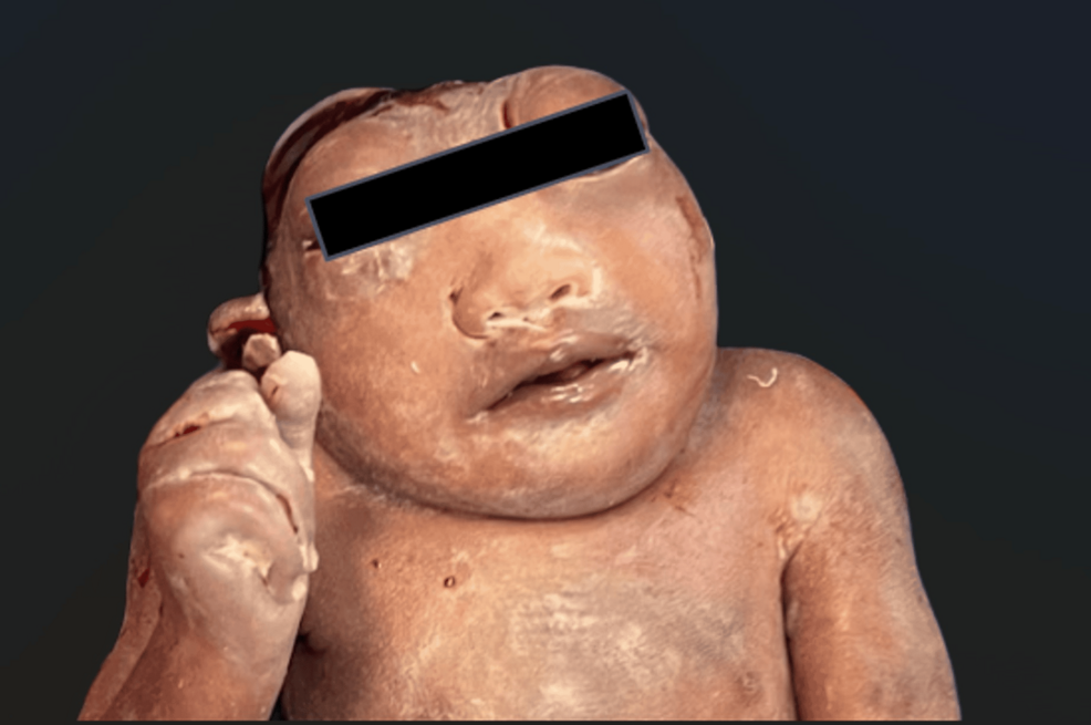 Incidental Prenatal Discovery of Anencephaly via Portable Ultrasounds in a Remote Medical Care Setting