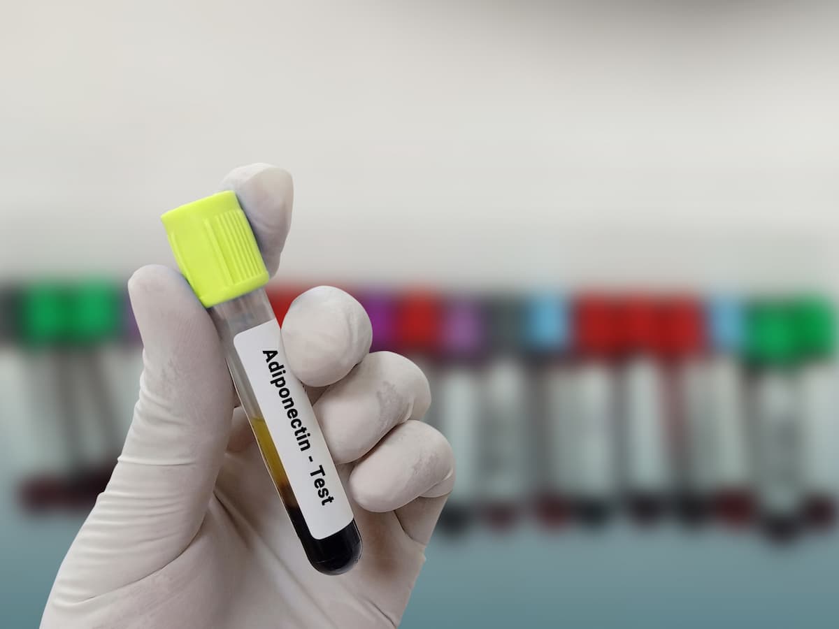 Elevated Adipokines an Independent Risk Factor for Fracture in RA