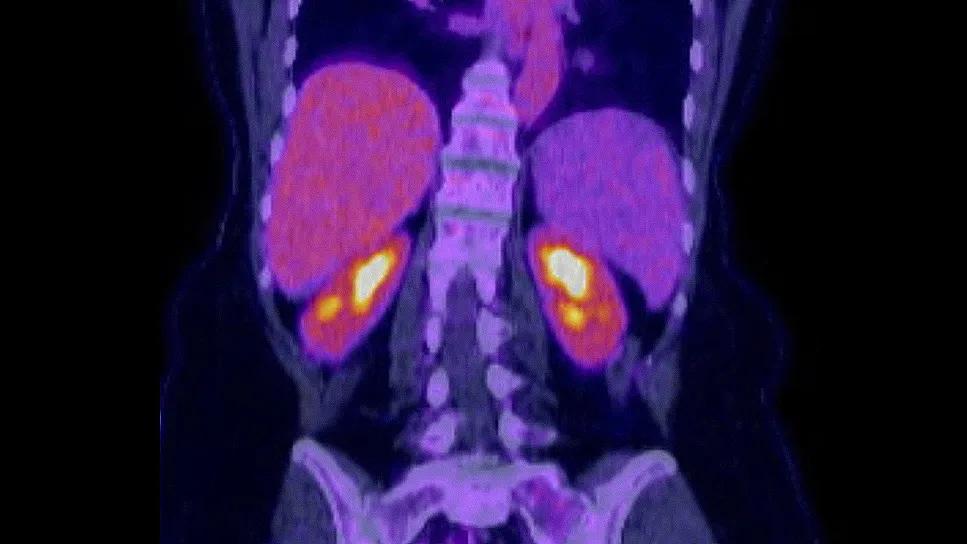 Patient with High-Risk Mantle Cell Lymphoma