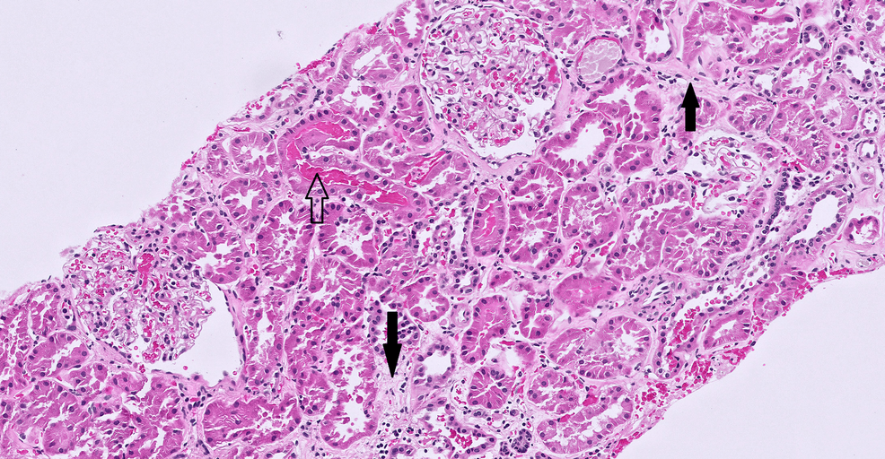 Treatment of Fibroblast Growth Factor-23-Mediated Renal Phosphate Wasting With Burosumab in a Patient With Chronic Kidney Disease 3b: A Case Report