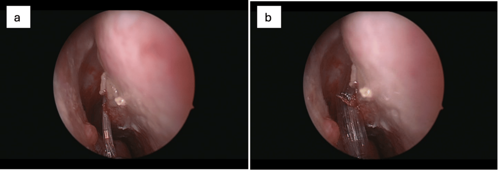 Preserving Function, Enhancing Precision: The Rise of Personalized Endonasal Sinus Surgery