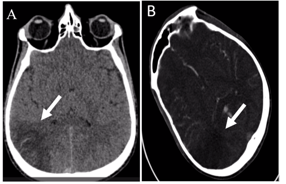 Thyrotoxicosis-Associated Hypercoagulability Leading to Concurrent Ischemic Stroke and Pulmonary Embolism in Graves’ Disease