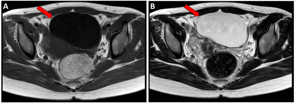 Early Return to Competition After vNOTES Ovarian Cystectomy in a Professional Athlete: A Case Report