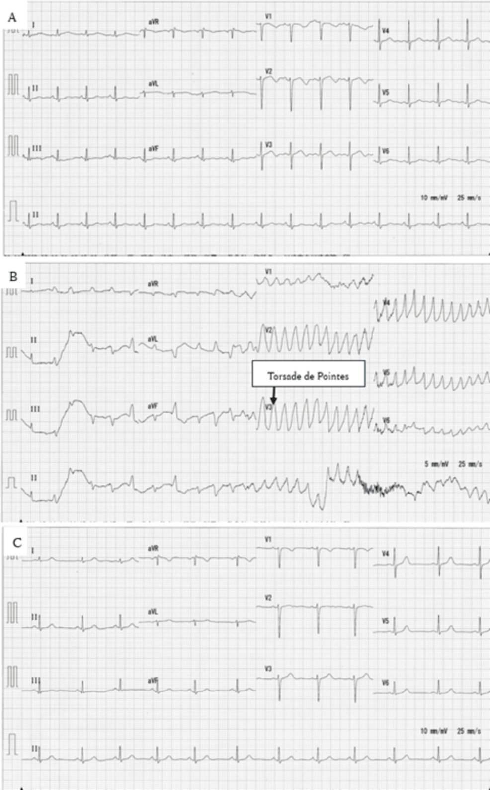 An Effective Critical Care Unit Admission Policy for Patients With Diphenhydramine Overdose: A Case Report