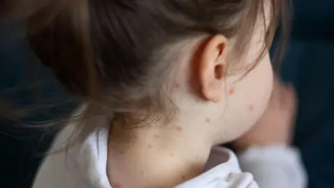 Getty Images Close-up of a girl taken from the back of her head with chickenpox measles visible on her neck and face.