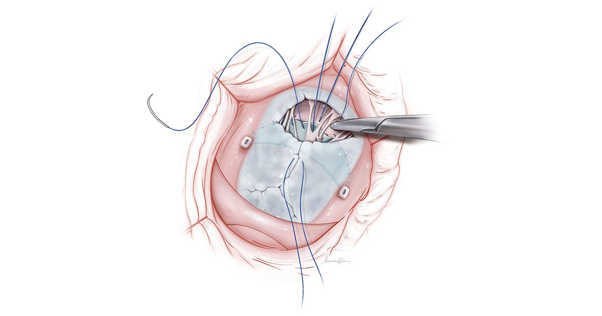 ‘Delicate’ and thoughtful approach to AVSD repair shows promise