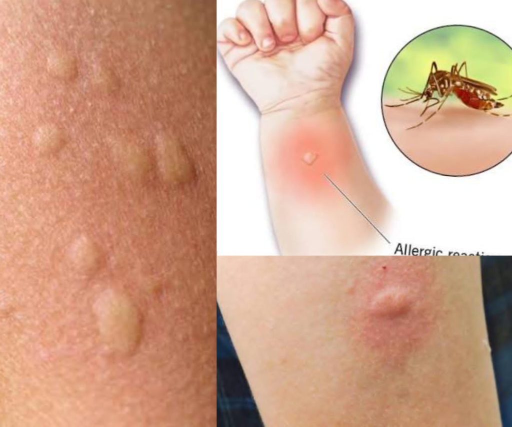 Mosquito Menace Worsens in Latifabad, Residents Fear Disease Outbreak – https://www.dailyindependent.com.pk