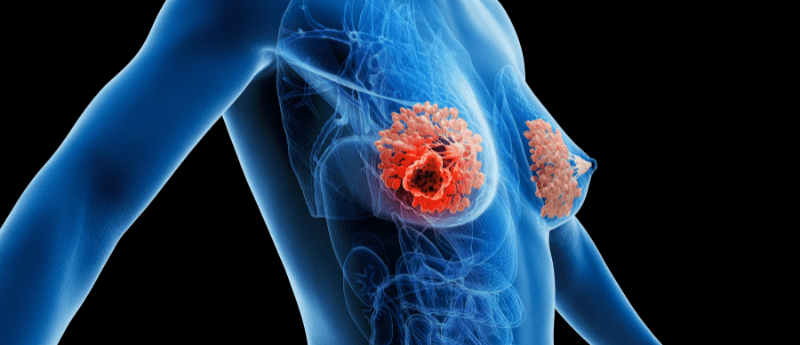 Cholesterol-lowering drug found to directly overcome chemotherapy resistance in TNBC cells