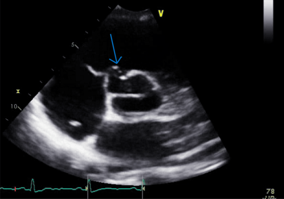 Incidental Finding of an Aneurysm of the Sinus of Valsalva in a Young Woman: A Management Dilemma
