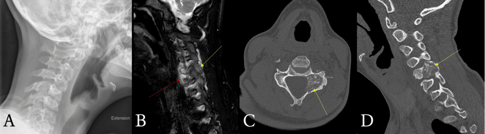 An Uncommon Cause of Cervical Pain in a Child: Osteoblastoma of the Cervical Spine