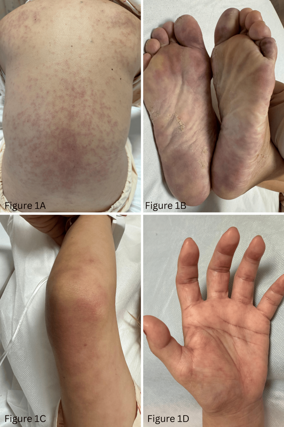 Atypical Interplay of Dermatomyositis, Metastatic Caecal Carcinoma, and Connective Tissue Disease
