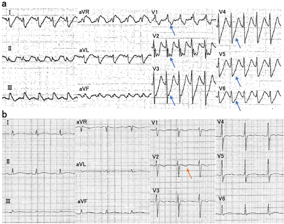 Survival Following a Tricyclic Antidepressant Overdose Presenting With Serotonin Syndrome-Like Symptoms and Critical Illness Polyneuropathy: A Case Report