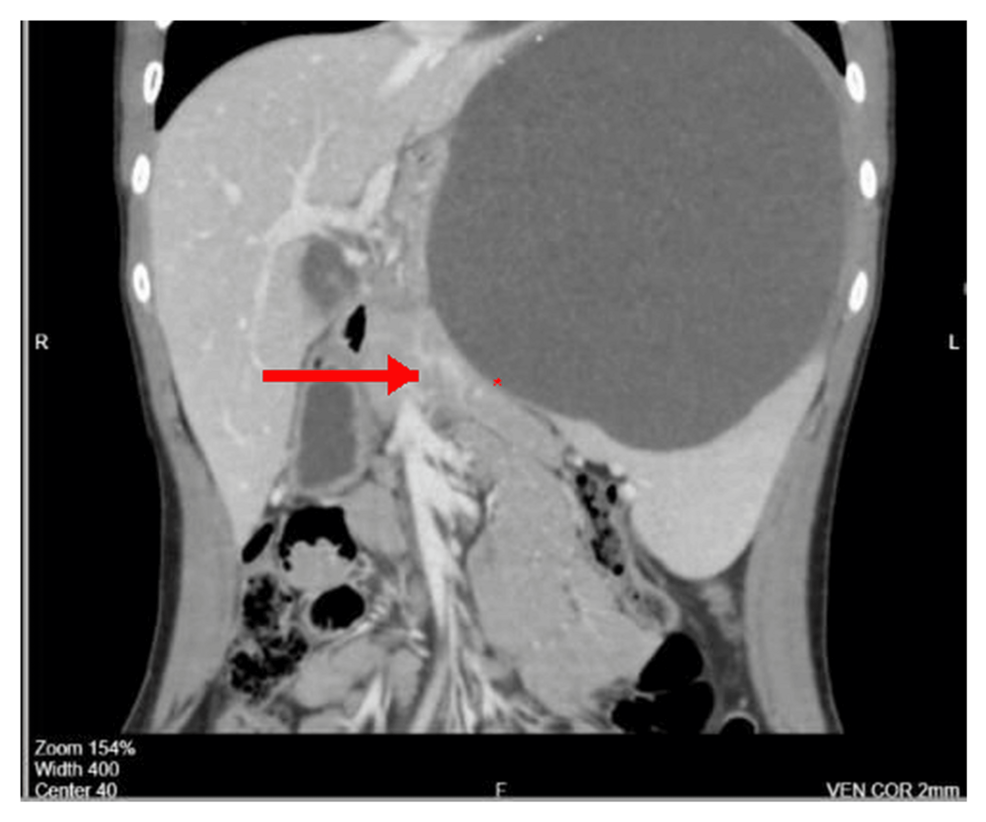 Giant Congenital Splenic Cyst in a Pediatric Patient: A Case Report and Review of Surgical Management