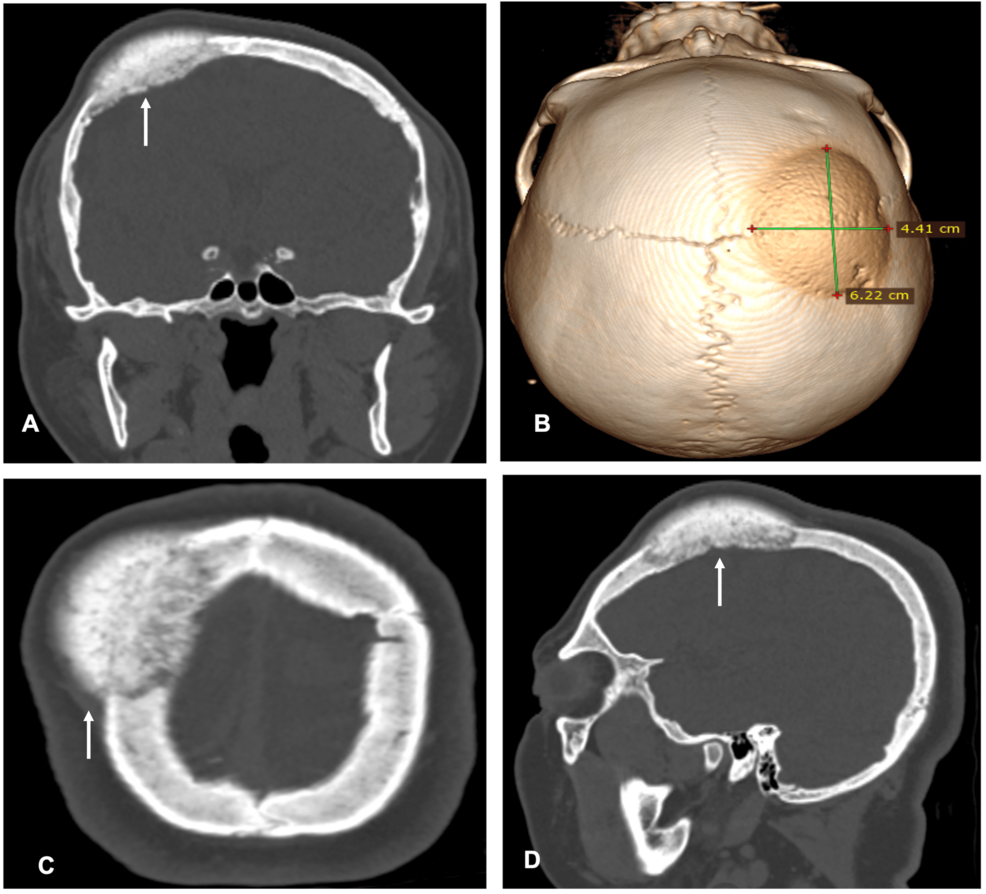 Single-Stage Resection and Reconstruction of Intraosseous Meningioma: The First Reported Case at Our Hospital