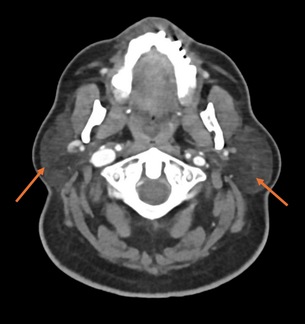 An Association Between Autoimmune Hepatitis (AIH) and Immunoglobulin G4-Related Disease (IgG4-RD) in a Male Diagnosed With Primary Sjögren’s Syndrome (SJS): A Case-Based Review
