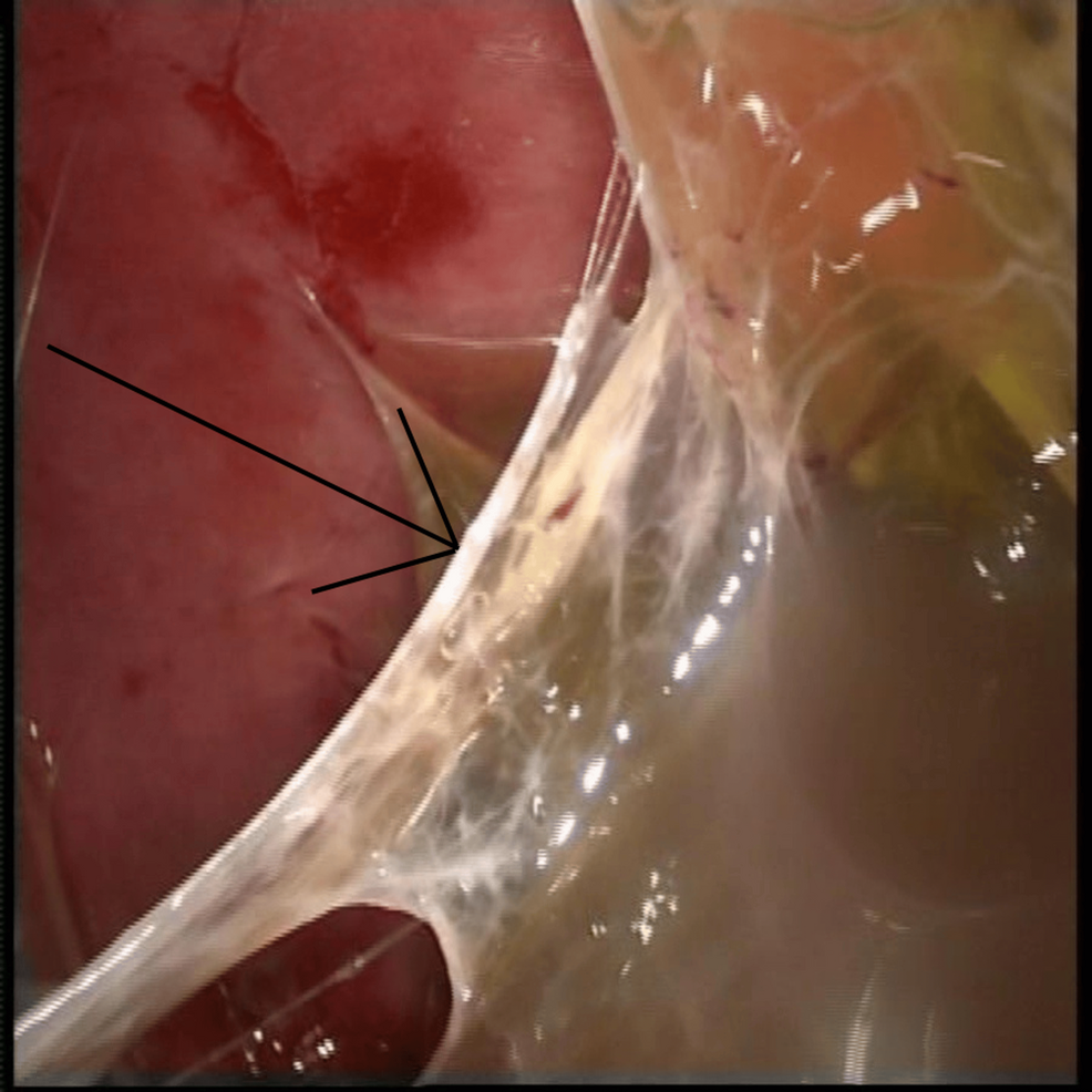 Video-Assisted Thoracoscopic Surgery for the Stage II Pleural Empyema: A Prospective Observational Study