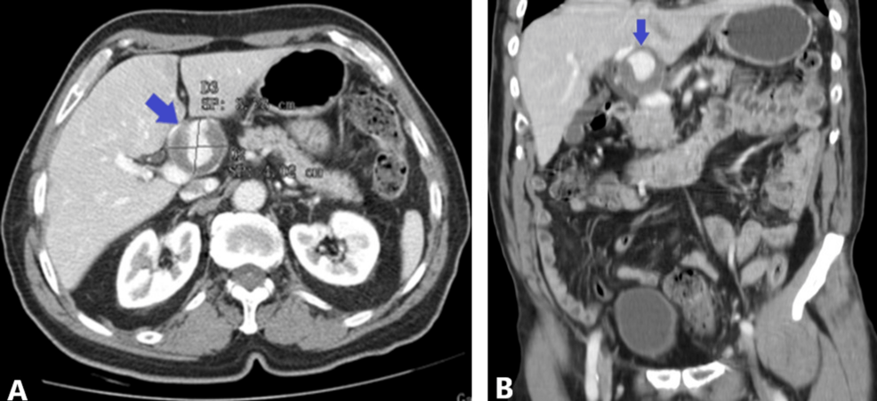 Late Recurrence of a Hepatic Artery Aneurysm Seven Years After Initial Coil Embolization: A Combined Endovascular Management