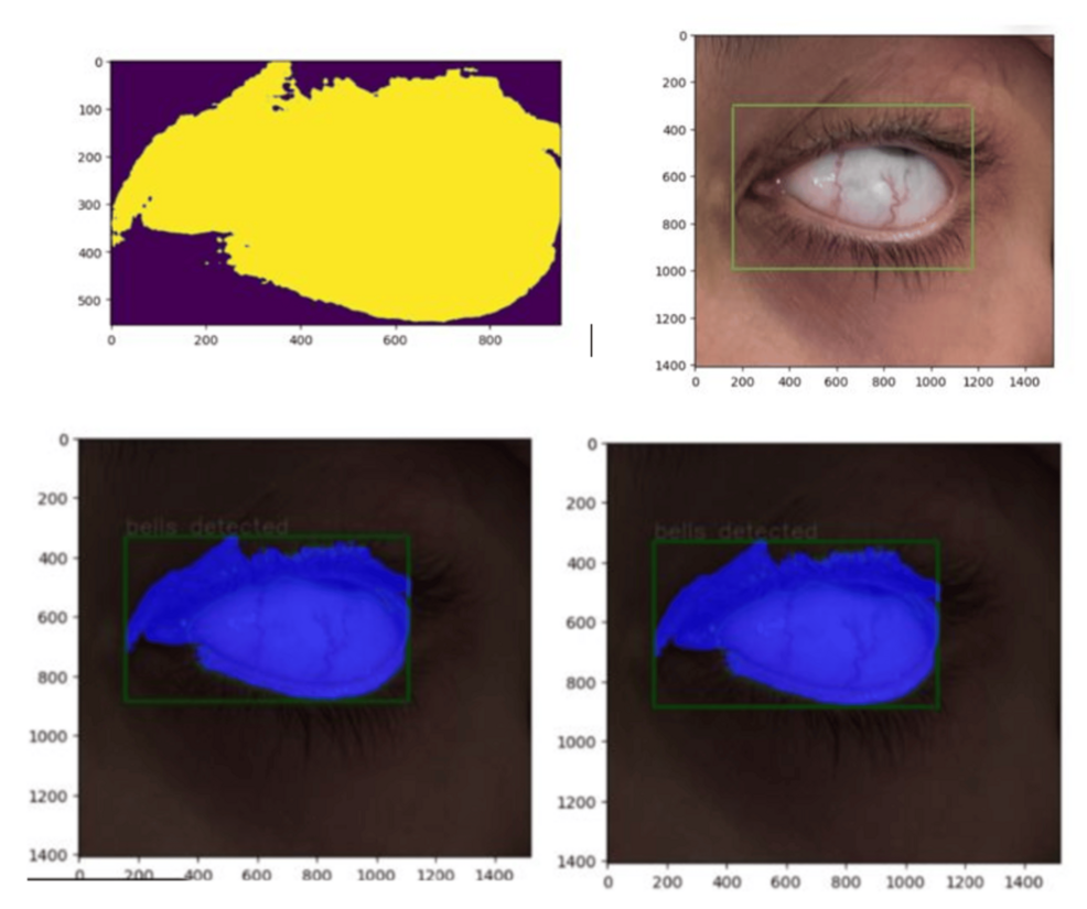 Developing an AI-Based Model for Lagophthalmos and Bell’s Phenomenon Detection in Intensive Care Unit Patients: A Gold Standard Comparison