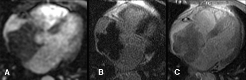 Primary Cardiac Lymphoma With Exceptional Long-Term Survival