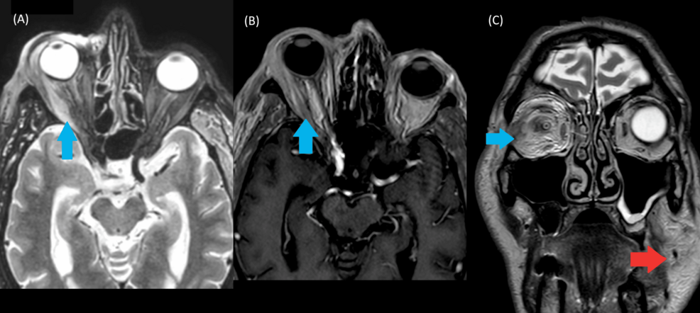 Expanding the Clinical Spectrum of VEXAS (Vacuoles, E1 Enzyme, X-linked, Autoinflammatory, Somatic) Syndrome: The First Report of Histologically Confirmed Neutrophilic Colitis With Rare Muscular and Pancreatic Involvement – Cureus