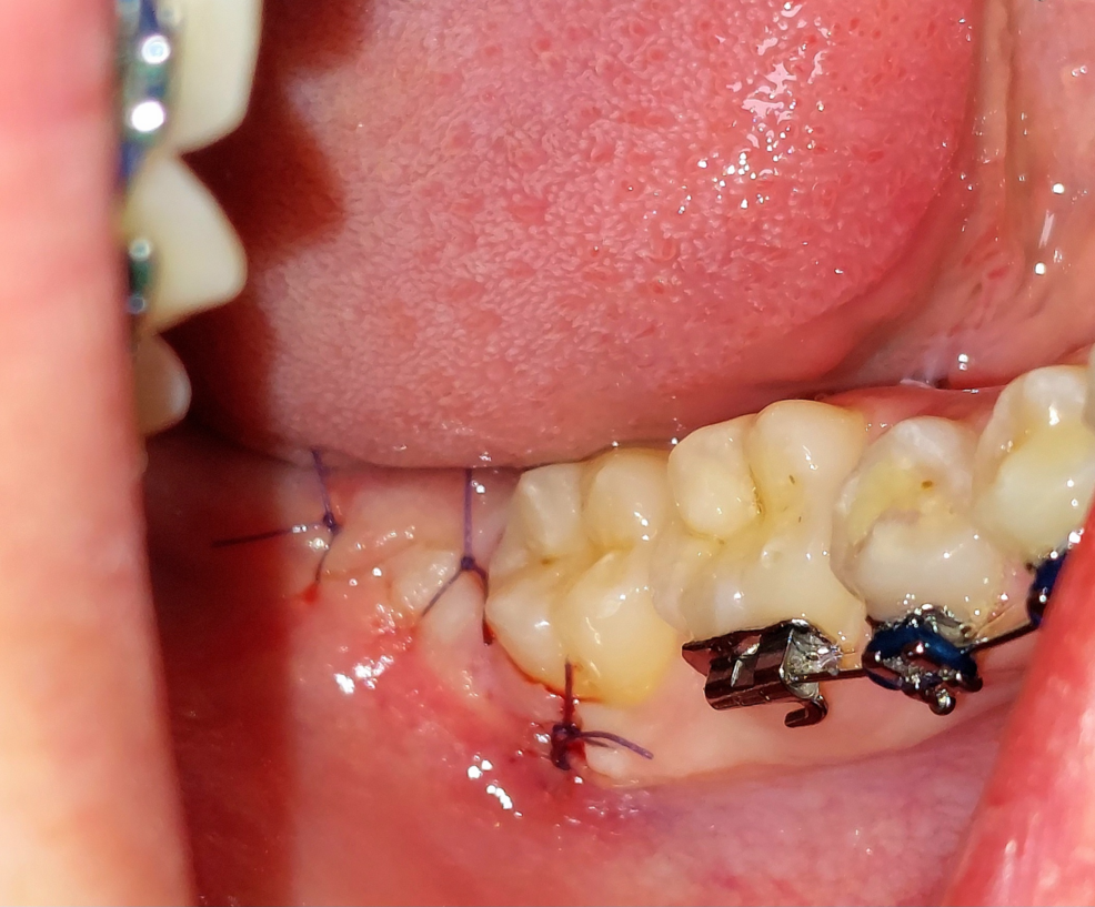 Iodine-Based Wound Dressing Versus Antibiotic Therapy for Postoperative Symptom Relief in Third Molar Surgery